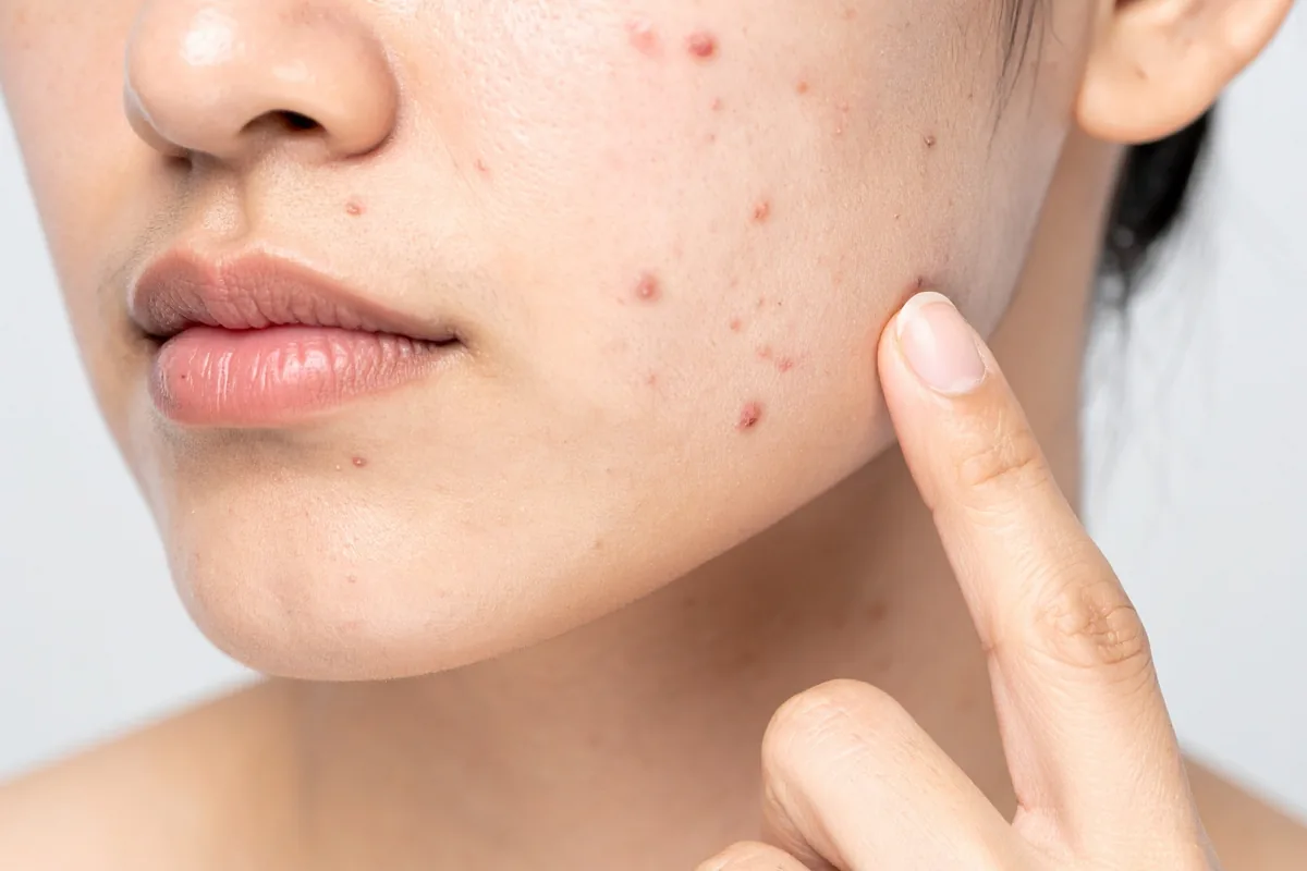 Acne Treatment — Dr. Negi's Clinic, Uttam Nagar Delhi