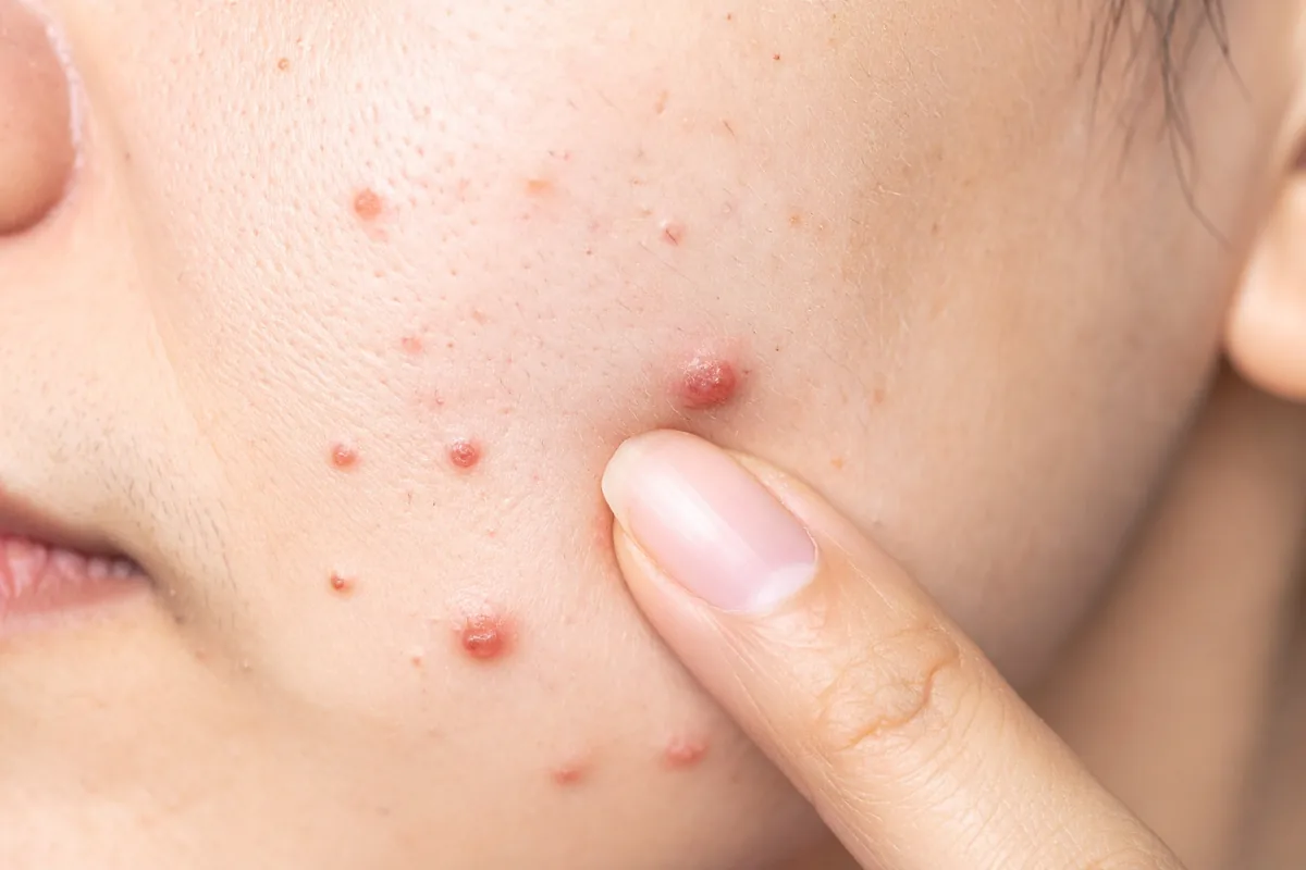 Hormonal Acne — Dr. Negi's Clinic, Uttam Nagar Delhi